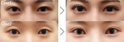 微晶眼贴有没有副作用_百消丹眼贴:有助于减轻眼疲劳并保护视力