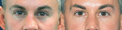双眼皮手术的疤痕多久变松_双眼皮手术的疤痕多久消失