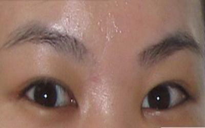 疤痕体质可以做近视眼手术吗