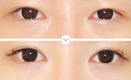 眼部整形中双眼皮手术常见并发症