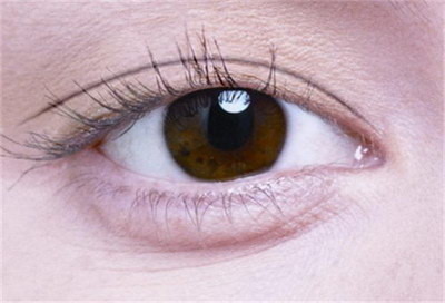 有效去除肿眼泡的最佳方法_治疗肿眼泡的方法
