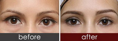 网上双眼皮精华有用吗_双眼皮做哪种好图片对比案例