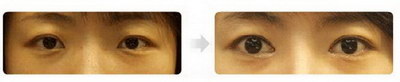 不通过手术改善眼角，可以采用哪些办法?_修复眼角起皱的方法