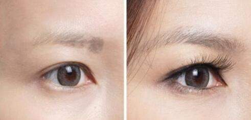 割的双眼皮疤痕怎么修复_双眼皮疤痕明显如何修复