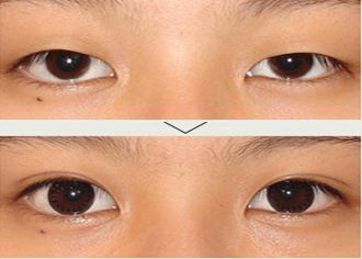 双眼皮手术几天不能沾水_双眼皮多久恢复正常