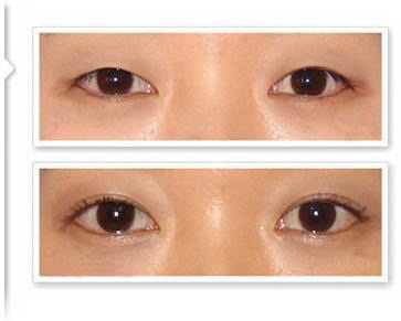 开眼角的方式有哪些_开眼角疤痕三个月还是疤痕凸起