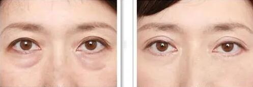 双眼皮术后多久可以用蒸汽眼罩【双眼皮术后多久可以喝牛奶】