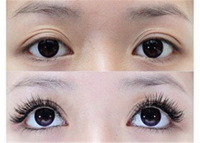 开眼角手术效果如何_开眼角手术和割双眼皮有什么区别