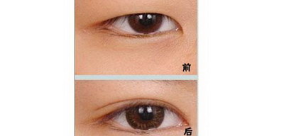 双眼皮术后大小眼能自然恢复吗(双眼皮术后大小眼能自然恢复吗)