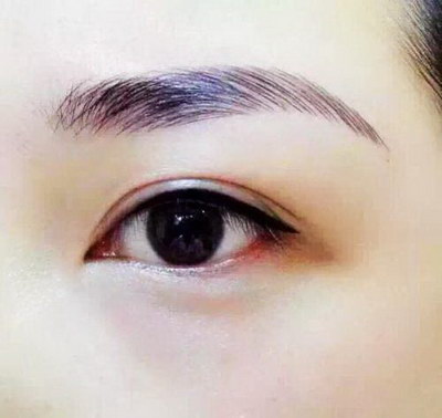 柳州割双眼皮手术