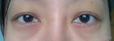 全切双眼皮开眼角多久能恢复正常_全切双眼皮开眼角的疤痕多久消除