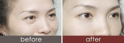 做韩式双眼皮手术教程