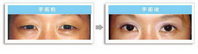全切双眼皮内缝线排出会影响手术效果吗