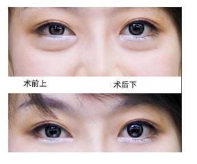 揭秘韩式双眼皮受欢迎的原因是什么？