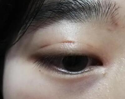 割双眼皮后遗症图_割双眼皮后遗症现象多吗