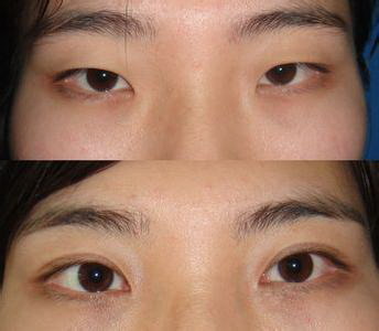 眼袋外切术后半年疤痕是白色的(眼袋外切手术后半个月下眼睑外翻)