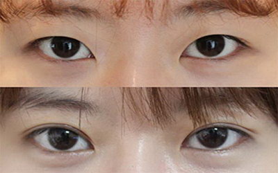 韩式微创双眼皮手术「韩式微创双眼皮手术要多长时间」