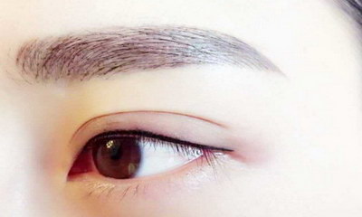 韩式三点式双眼皮缺点「韩式三点式双眼皮介绍」