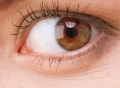 双眼皮修复术后的注意事项都有什么呢？