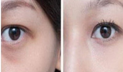双眼皮和近视眼手术哪个先做_做过近视眼手术能割双眼皮吗