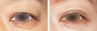 修复双眼皮的效果如何？