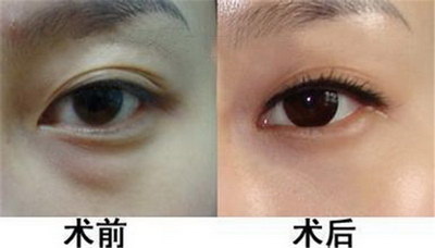 眼睛经常有黑眼圈是什么原因引起的