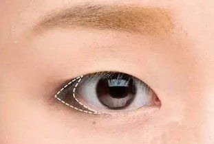 眼睛出现发炎能做双眼皮手术吗？