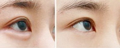 双眼皮修复恢复的时间是不是长(双眼皮修复恢复需要多长时间？)