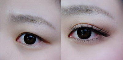韩式双眼皮是否能永久有效呢？
