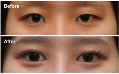 眼部针灸对近视有效吗