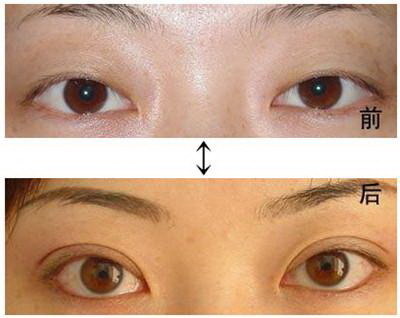 眼睑下垂是什么症状「什么是眼睑下垂症状」