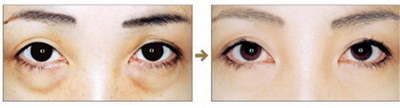 了解一下双眼皮手术的方法都有哪些？