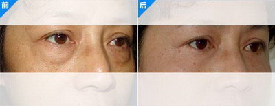 双眼皮手术后如何预防留疤——一些术后注意事项