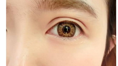 常见的埋线双眼皮适应症是什么