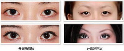 哪种双眼皮手术恢复的更快呢？