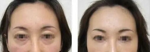 眼袋抽脂术后注意事项有哪些_眼袋抽脂术后消肿的方法