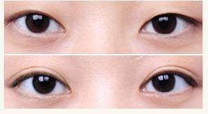 为什么韩式微创双眼皮术那么受欢迎