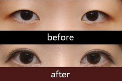 去黑眼圈手术一生能做几次(什么是去黑眼圈手术？)