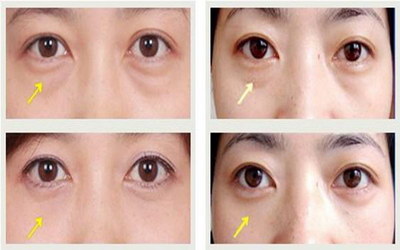 超声波去眼袋效果：一种改善下垂眼睑的新方法