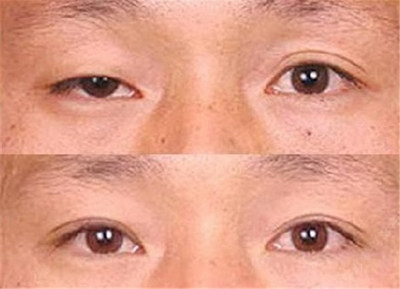 做完双眼皮怎么护理才能保持好形状(双眼皮手术后的护理方法)