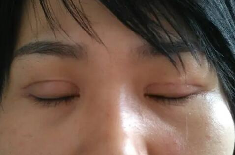 眼袋外切术后半年疤痕是白色的(眼袋外切手术后半个月下眼睑外翻)
