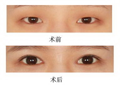 北京哪里做韩式双眼皮「想问北京韩式双眼皮医院哪里好」