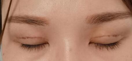 双眼皮手术后多久疤痕才会消_双眼皮手术后抹什么不留疤痕