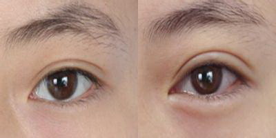 眼袋眼角纹怎样去除 针灸祛除眼袋疗效稳定