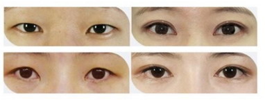 双眼皮效果不好怎样可以退款_双眼皮修复成功率高吗？