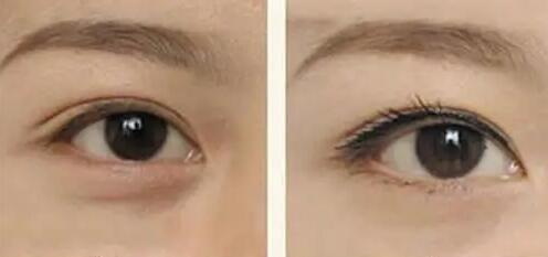 小眼睛肿眼泡割双眼皮手术:改善外观和质量(小眼睛肿眼泡割双眼皮恢复过程)