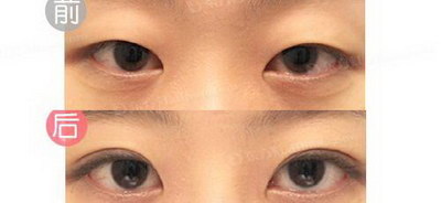 眼皮松弛像双眼皮什么原因？