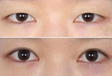 男生适合割什么类型的双眼皮_瘦了之后割的双眼皮会有影响