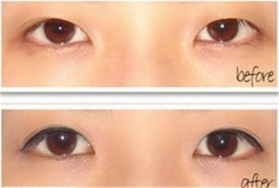 双眼皮术后眼角增生的治疗方法(双眼皮手术后眼角增生特别明显)