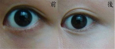 男人双眼皮全切恢复过程_双眼皮全切是什么